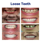 AQA™-New Generation Flexible Full Denture Solution(ADA recommended)(🎁Flash Sale - Don’t Miss Out)