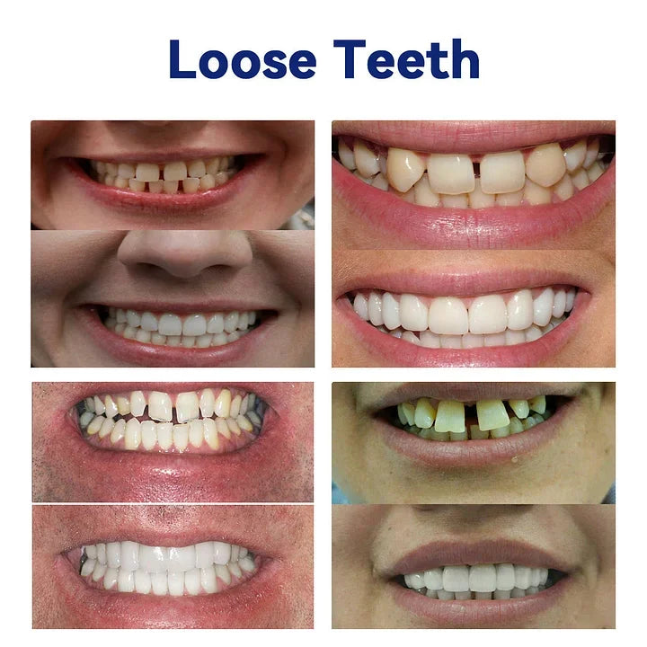 AQA™-New Generation Flexible Full Denture Solution(ADA recommended)(🎁Flash Sale - Don’t Miss Out)