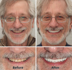 AQA™ – Advanced Custom-Fit Functional Dentures🦷(ADA recommended)(🎁Flash Sale - Don’t Miss Out)