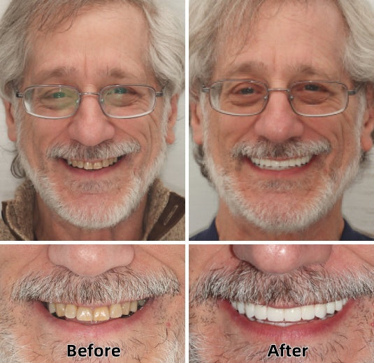 AQA™ – Advanced Custom-Fit Functional Dentures🦷(ADA recommended)(🎁Flash Sale - Don’t Miss Out)