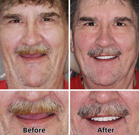 AQA™ – Advanced Custom-Fit Functional Dentures🦷(ADA recommended)(🎁Flash Sale - Don’t Miss Out)