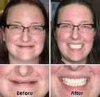 AQA™ – Advanced Custom-Fit Functional Dentures🦷(ADA recommended)(🎁Flash Sale - Don’t Miss Out)