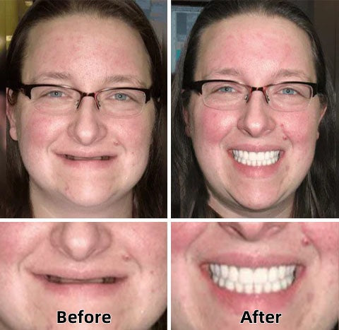 AQA™ – Advanced Custom-Fit Functional Dentures🦷(ADA recommended)(🎁Flash Sale - Don’t Miss Out)